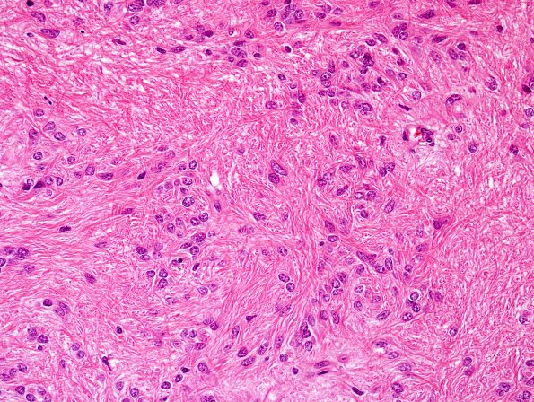 2C5 Subependymoma (Case 2) H&E 3