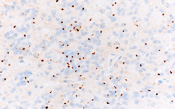 2E1 Subependymoma (Case 2) D2-40 40X areaC