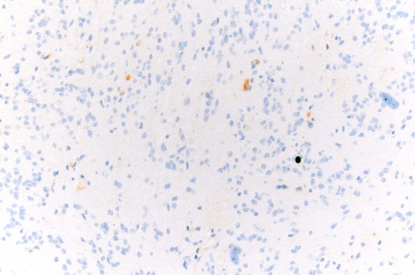 2F Subependymoma (Case 2) Ki67 20X areaC