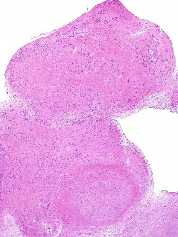 3B2 Subependymoma (Case 3) H&E 2.