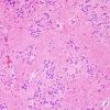 3B3 Subependymoma (Case 3) H&E 