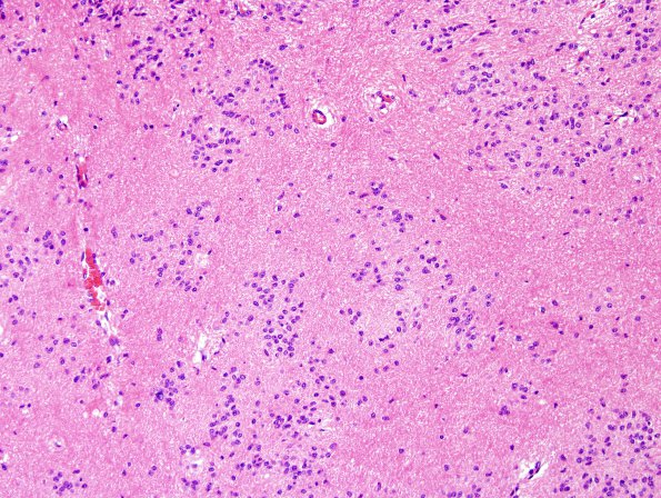 3B3 Subependymoma (Case 3) H&E 