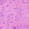 3B4 Subependymoma (Case 3) H&E 7