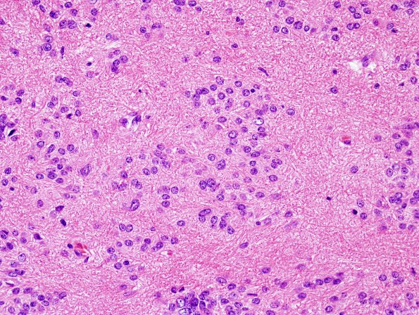 3B4 Subependymoma (Case 3) H&E 7