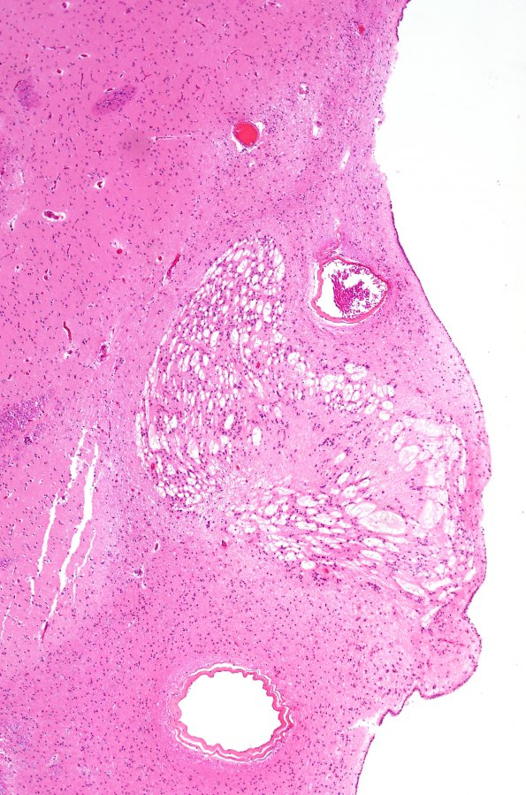 4A2 Subependymoma (Case 4) H&E 1