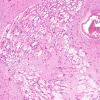 4A3 Subependymoma (Case 4) H&E 3