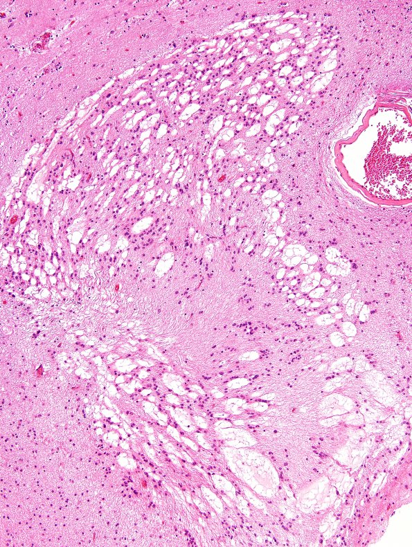 4A3 Subependymoma (Case 4) H&E 3