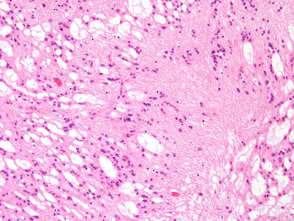 4A4 Subependymoma (Case 4) H&E 2