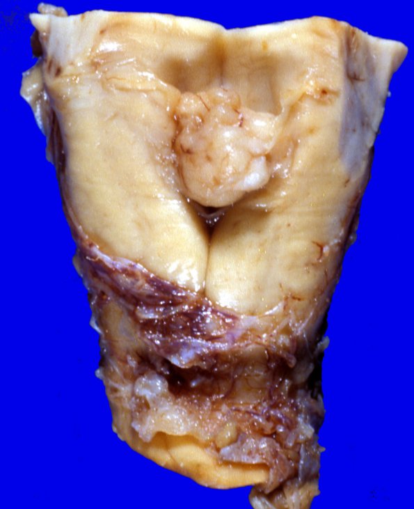 5A1 Subependymoma (Case 5) gross 1