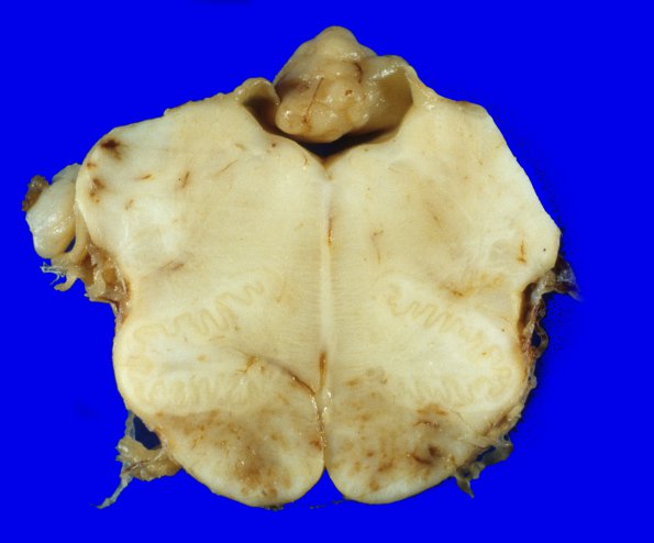 5A2 Subependymoma (Case 5) gross 3