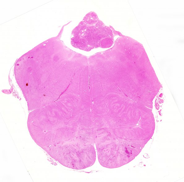 5B1 Subependymoma (Case 5) H&E WM 1