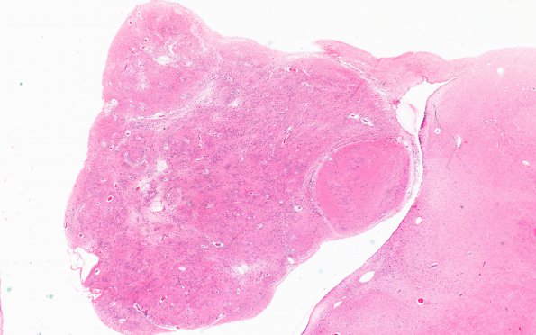 5B2 Subependymoma (Case 5) H&E 2X