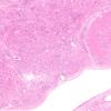 5B3 Subependymoma (Case 5) H&E 4X