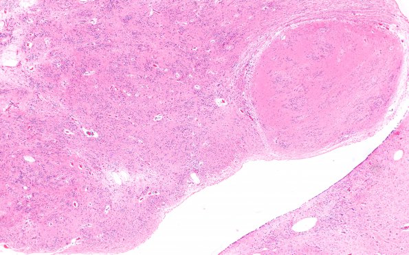 5B3 Subependymoma (Case 5) H&E 4X