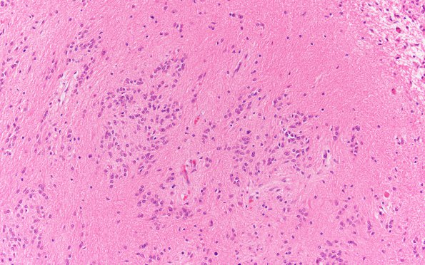 5B4 Subependymoma (Case 5) H&E 20X 2