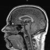 6A1 Subependymoma (Case 6) T1 1 - Copy