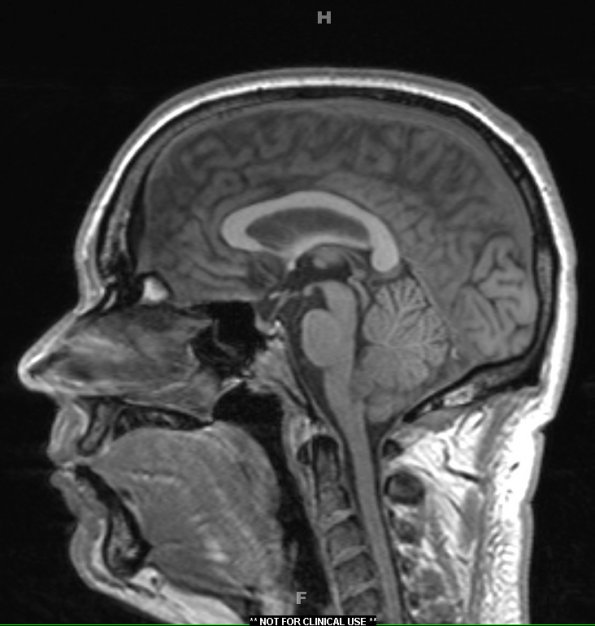 6A1 Subependymoma (Case 6) T1 1 - Copy