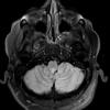 6A2 Subependymoma (Case 6) TIRM 1 - Copy