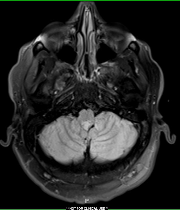 6A2 Subependymoma (Case 6) TIRM 1 - Copy