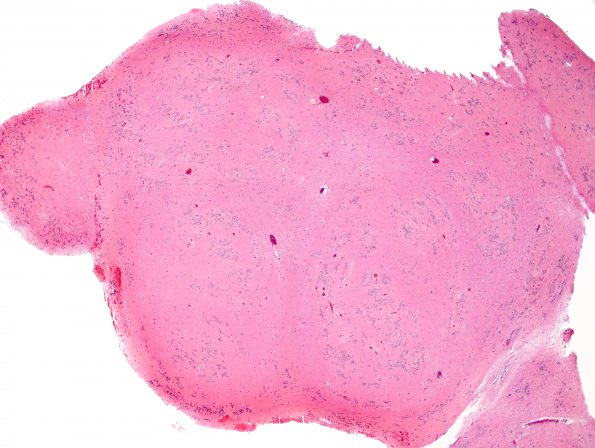 6B1 Subependymoma (Case 6) H&E 2.