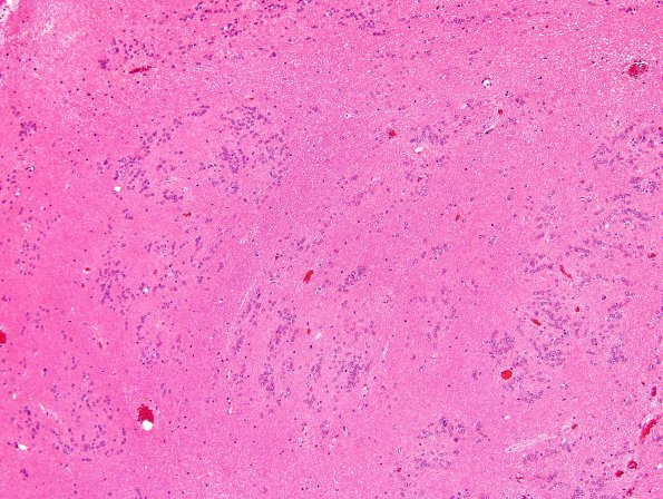 6B2 Subependymoma (Case 6) GFAP 10X 3