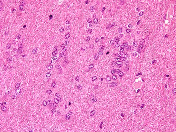 6B4 Subependymoma (Case 6) H&E 1