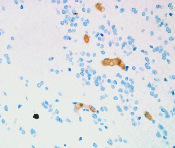 6D Subependymoma (Case 6) Ki67 1