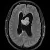 7A1 Subependymoma (Case 7) TIRM 1 - Copy