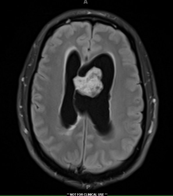 7A1 Subependymoma (Case 7) TIRM 1 - Copy