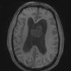 7A2 Subependymoma (Case 7) T1 1 - Copy