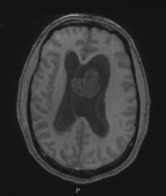 7A2 Subependymoma (Case 7) T1 1 - Copy