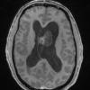 7A3 Subependymoma (Case 7) T1W 1 - Copy