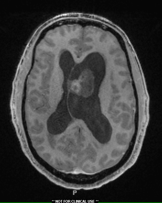 7A3 Subependymoma (Case 7) T1W 1 - Copy