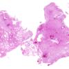 7B1 Subependymoma (Case 7) H&E whole mount