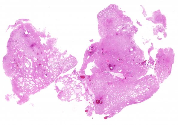 7B1 Subependymoma (Case 7) H&E whole mount