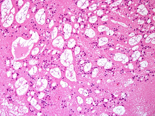 7B2 Subependymoma (Case 7) H&E 6