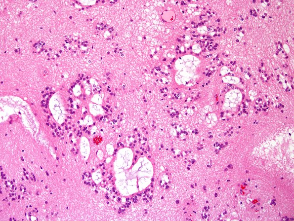 7B3 Subependymoma (Case 7) H&E 2