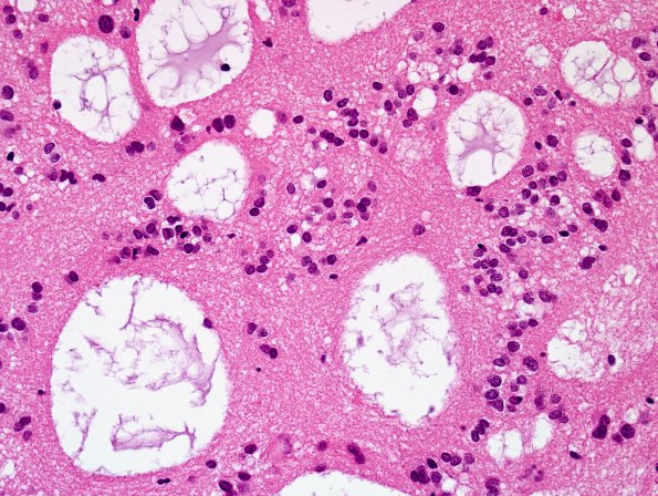 7B4 Subependymoma (Case 7) H&E 10