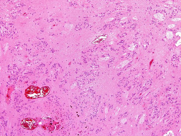 7B5 Subependymoma (Case 7) H&E 10X 1