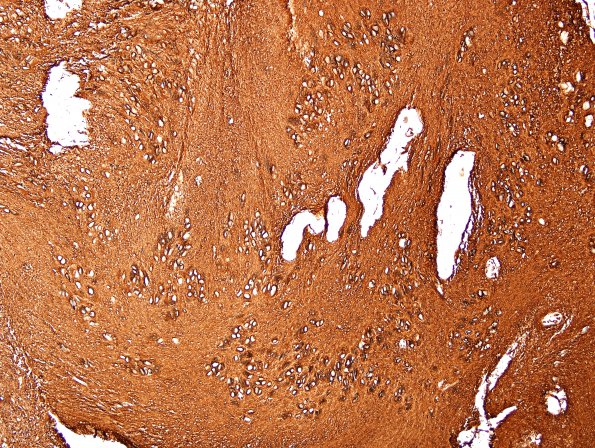 7C Subependymoma (Case 7) GFAP 3