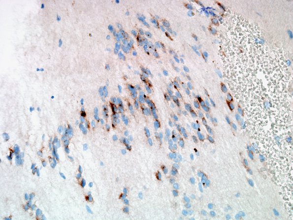 7D1 Subependymoma (Case 7) EMA 3