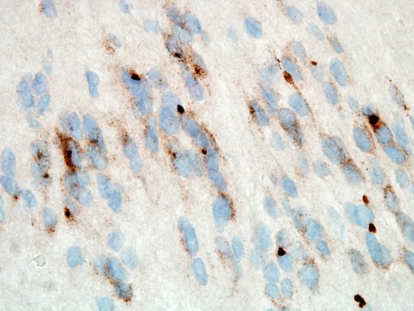 7D2 Subependymoma (Case 7) EMA 2.jpg