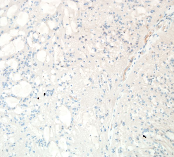 7E1 Subependymoma (Case 7) Ki67 1