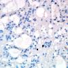 7E2 Subependymoma (Case 7) Ki67 2