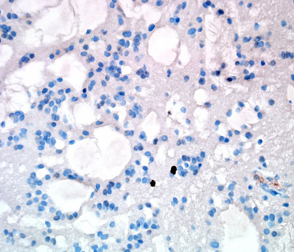 7E2 Subependymoma (Case 7) Ki67 2