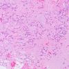 8A2 Subependymoma (Case 8) H&E 1