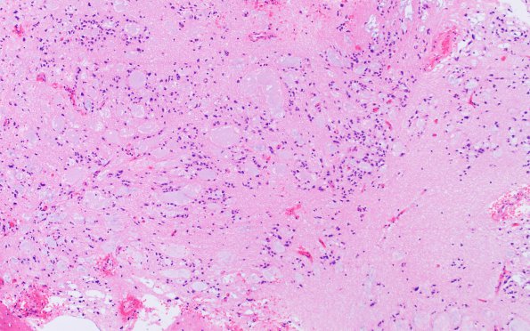 8A2 Subependymoma (Case 8) H&E 1