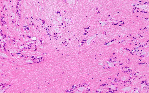 8A3 Subependymoma (Case 8) H&E 5