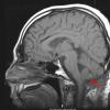 9A1 Subependymoma (Case 9) T1 - Copy copy