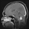 9A2 Subependymoma (Case 9) T1 Post-GAD (2) - Copy